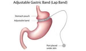 gastric banding